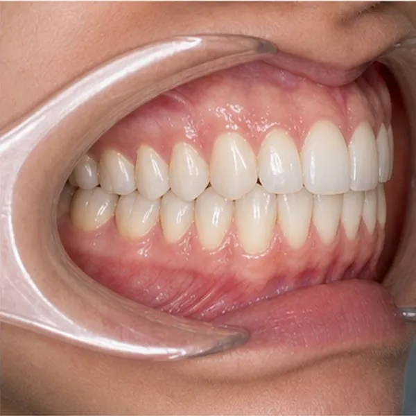 Vista clínica: Intraoral D