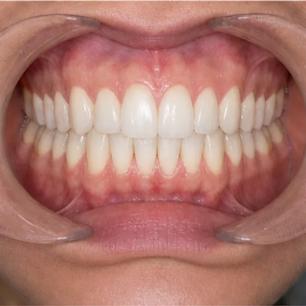 Vista clínica: Intraoral F